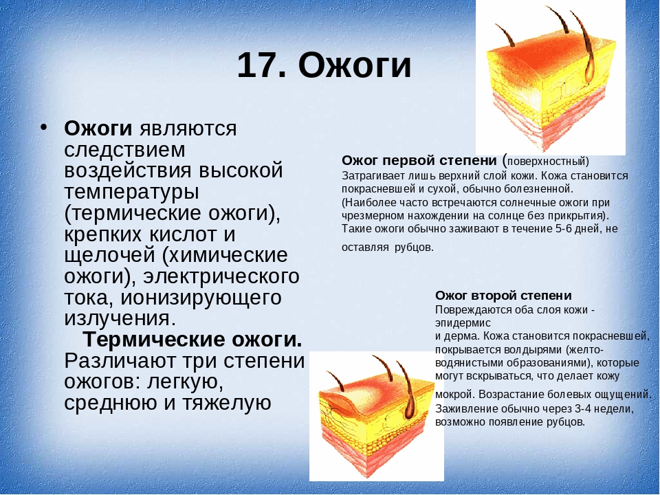 Презентация на тему ожоги