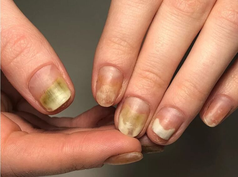Узнайте и вы причины расслоения ногтей! | красивые ногти - дополнение твоего образа