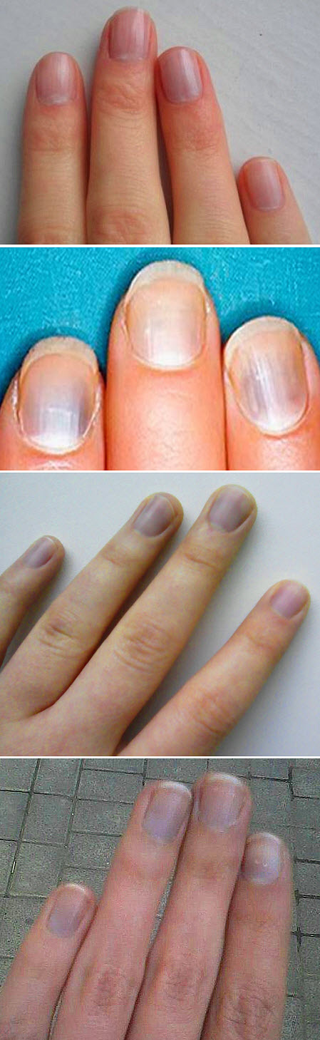 Почему ногти синеют причина. Синюшные ногтевые пластины. Синеватые ногти на руках. Синеватый цвет ногтей ногтевой пластины.