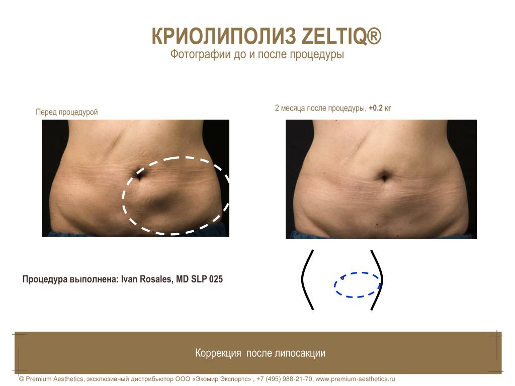 Процедура криолиполиз: отзывы, фото до и после, описание и особенности :: syl.ru