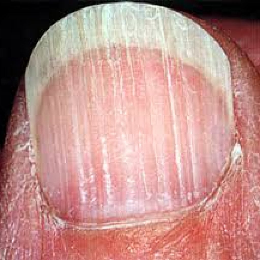 Трещины на ногтях рук вдоль ногтя, причины, фото и чем лечить