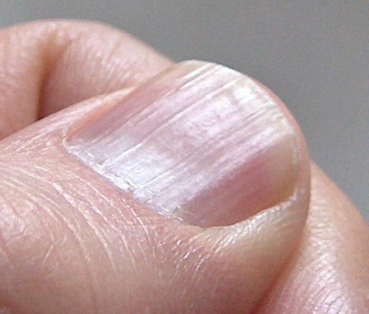 Волнистые ногти на больших пальцах рук: причины