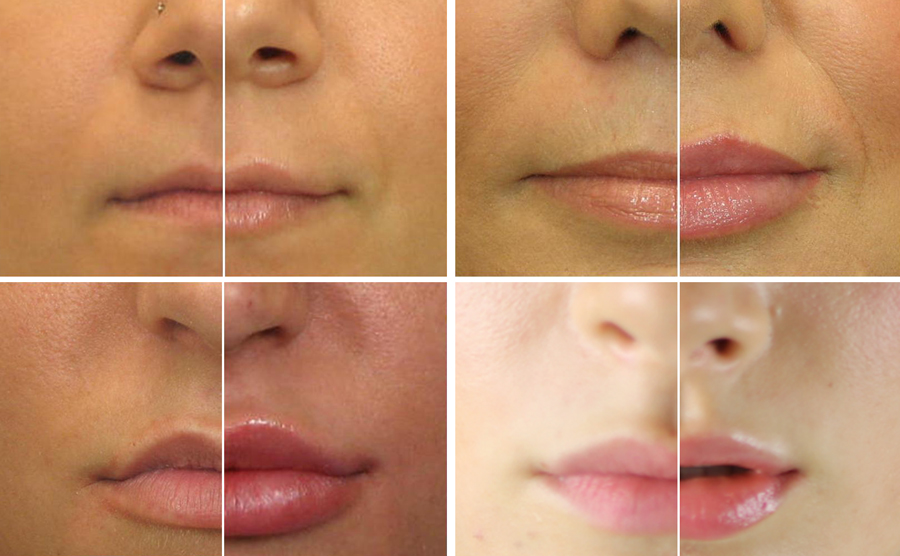 Фото до и после губы гиалуроновой кислотой