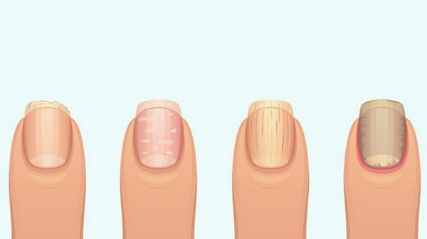 Как исправить некрасивую форму ногтей на руках