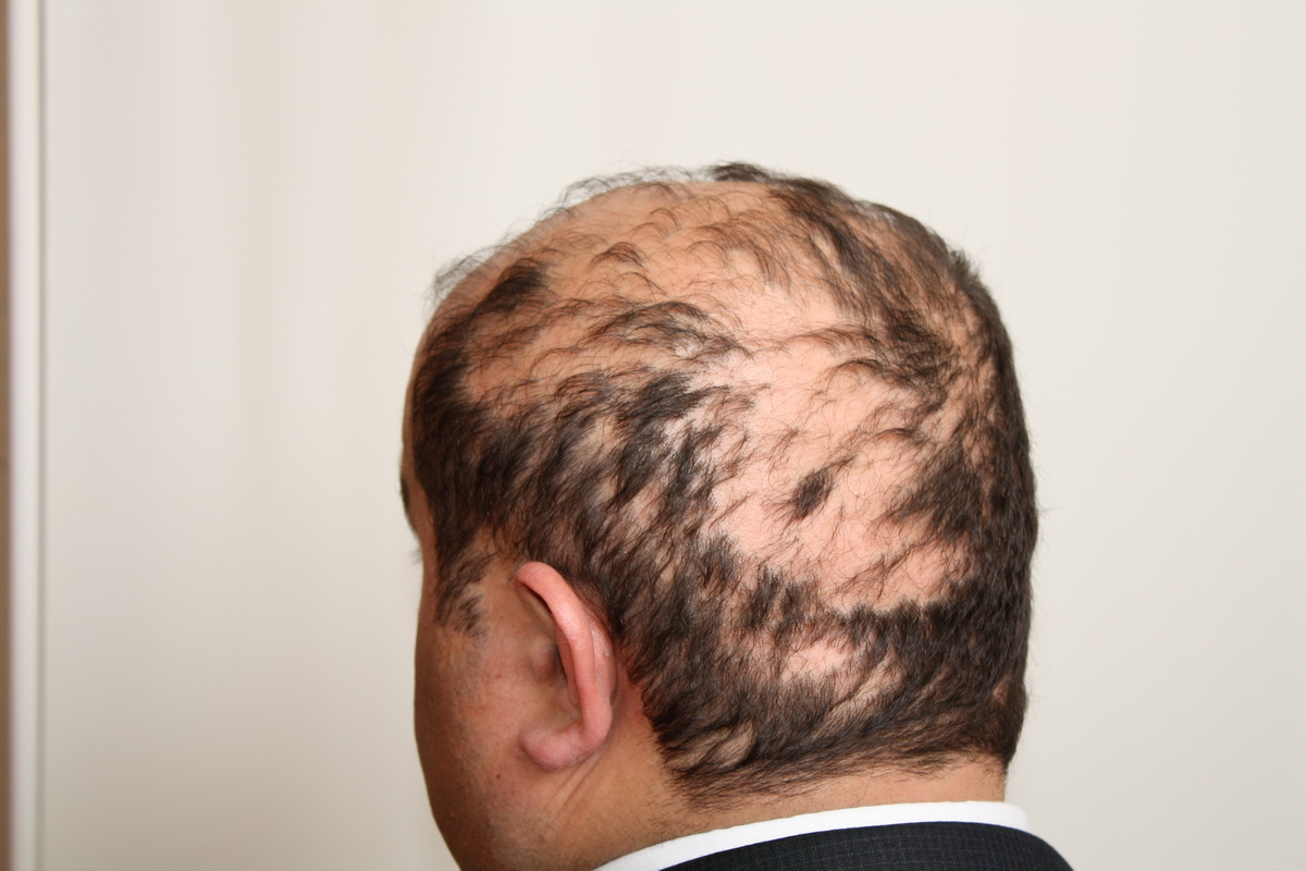 Какой врач лечит выпадение волос на голове у мужчин