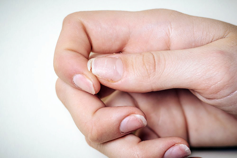 Слоятся ногти на руках: причины и лечение