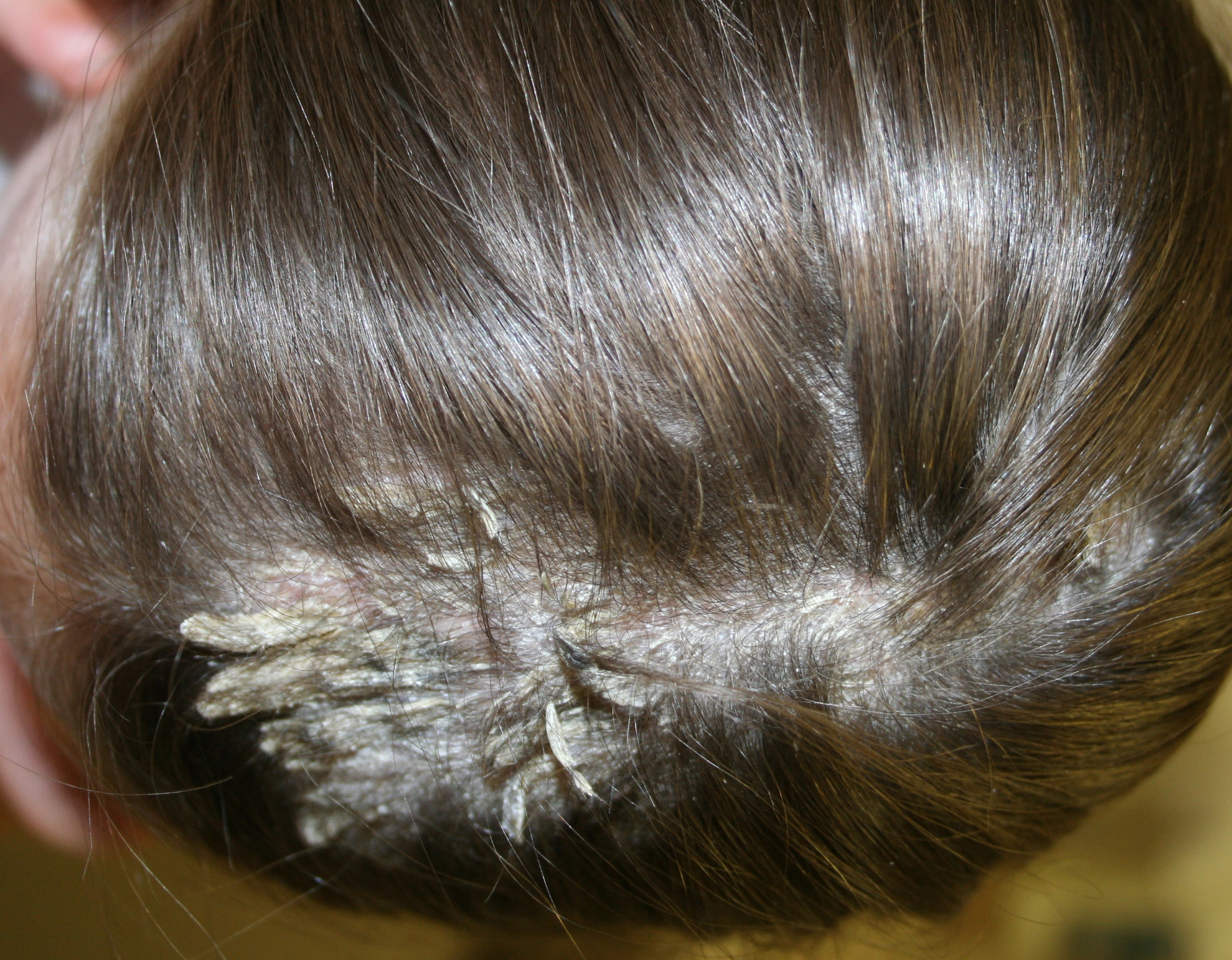 Болячки на голове - коросты в волосах, почему чешется голова, причины и чем лечить у ребенка и у взрослых, фото