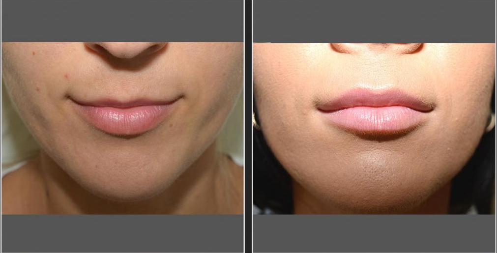 Увеличение губ гиалуроновой кислотой: фото процедуры