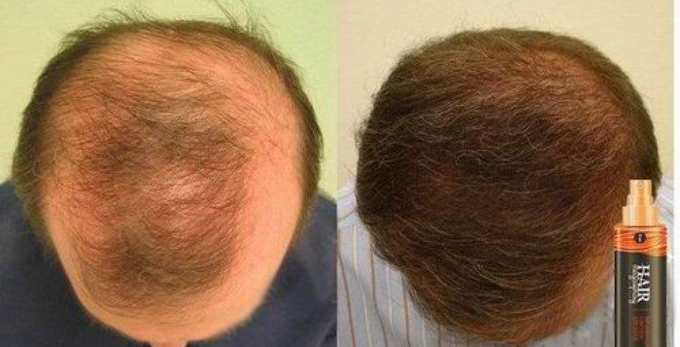 Могут ли вырасти волосы после облысения у мужчин