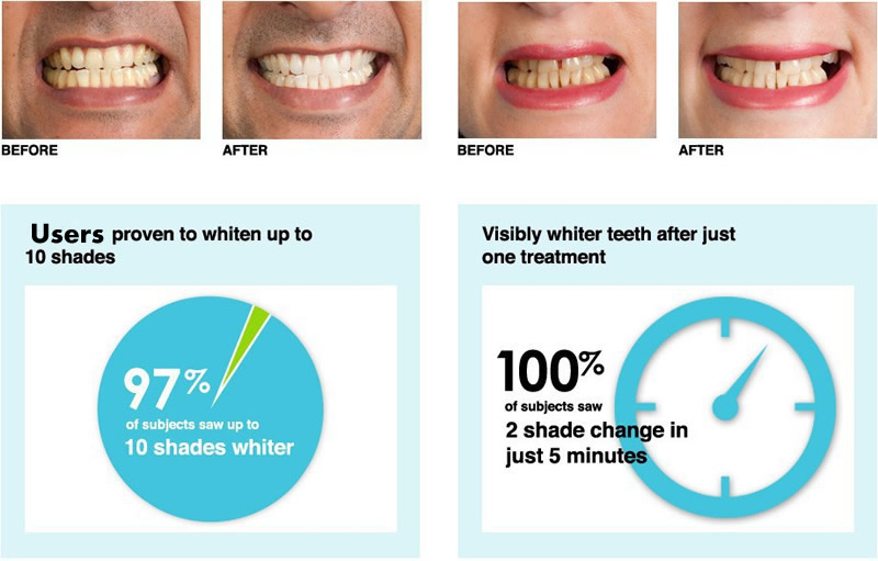 Полоски для отбеливания зубов: как применять, плюсы и минусы