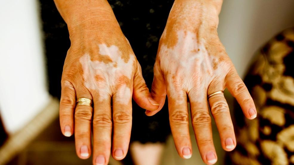 Депигментация кожи (витилиго). отчего на коже появляются белые пятна, диагностика и возможные методы лечения