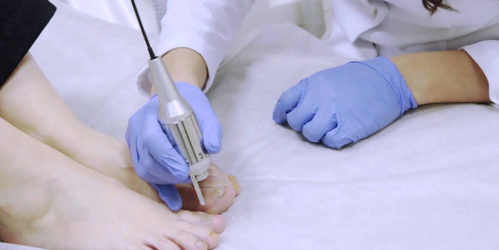 Лазерное лечение грибковых ногтей и гиперкератоза | подолог фортунская лариса