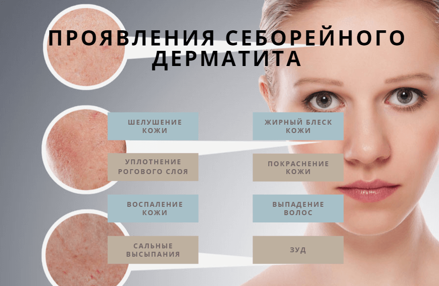 Лечение жирной и сухой себореи на лице: медикаментозные и народные средства