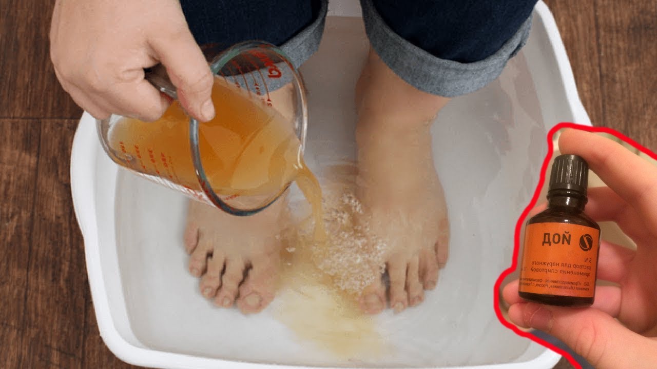 Как быстро избавиться от грибка ногтей на ногах в домашних условиях