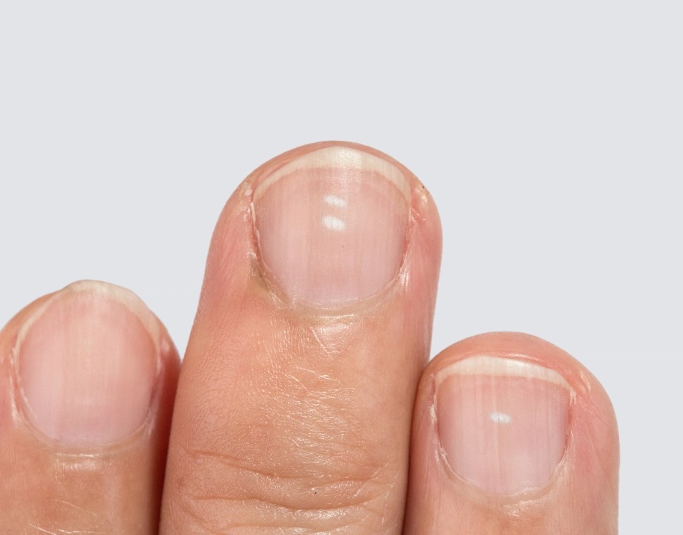 Волны на ногтях: что это значит, чего не хватает и почему стали появляться на больших и иных пальцах рук правой и левой, а также механические причины и лечение