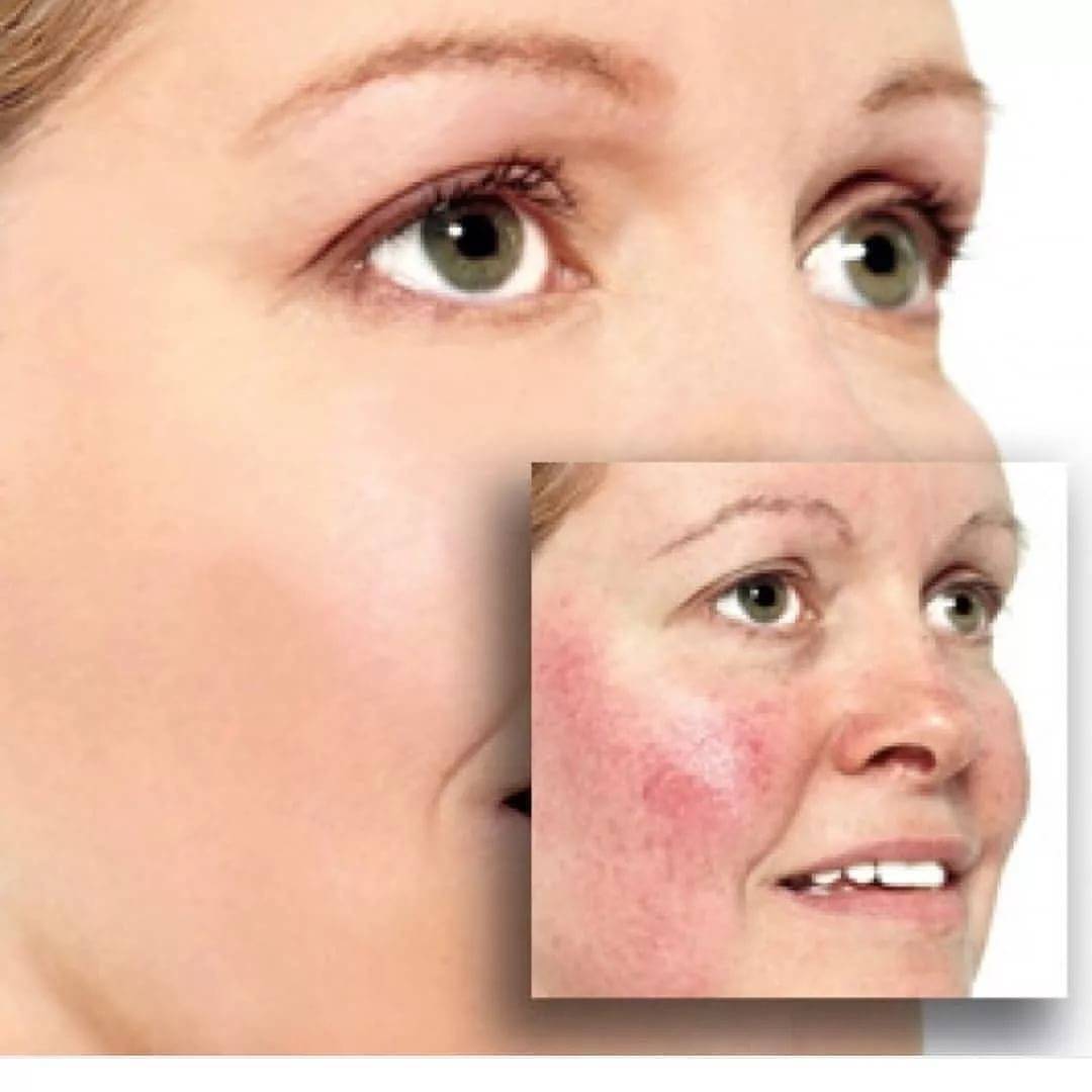 Лечение купероза на лице
