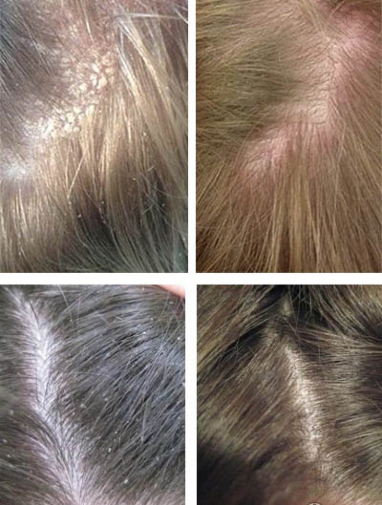 Гниды на волосах: что это, как выглядят, откуда берутся и чем лечить?