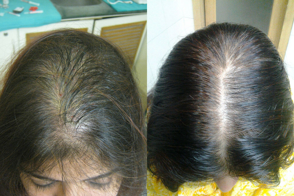Можно ли восстановить волосы при андрогенном облысении у женщин