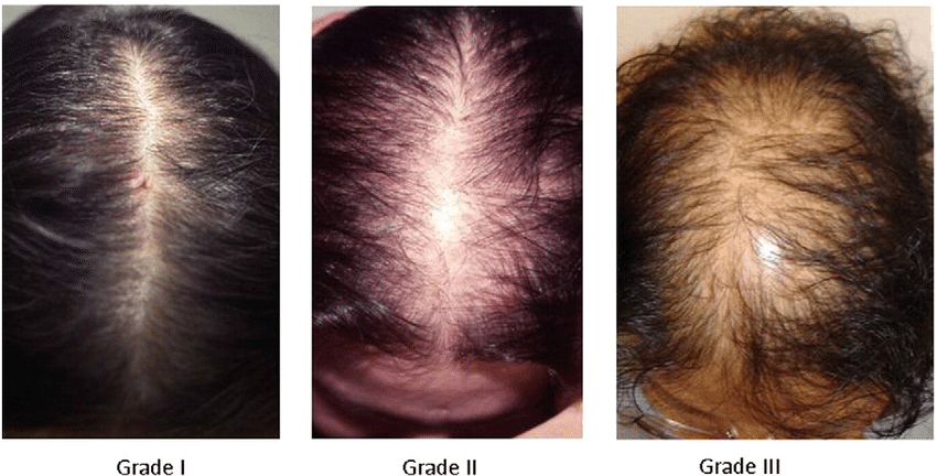 Выпадение волос – причины, диагностика, современное лечение * клиника диана в санкт-петербурге