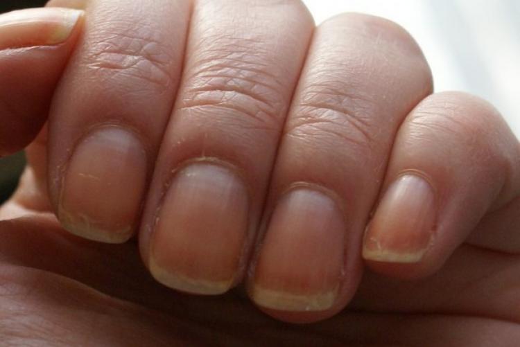 Онихомикоз: профилактика грибка ногтей