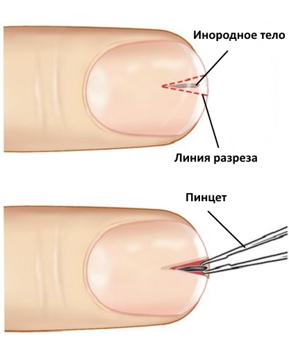 ᐉ как извлечь из-под ногтя занозу -