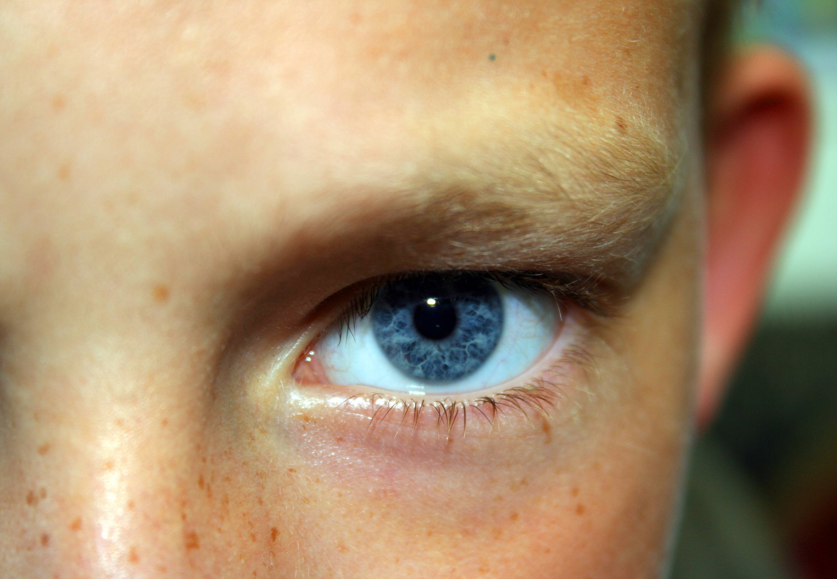 Точки около глаз. Пигментация кожи вокруг глаз. Пигментация вокруг глаз у детей.