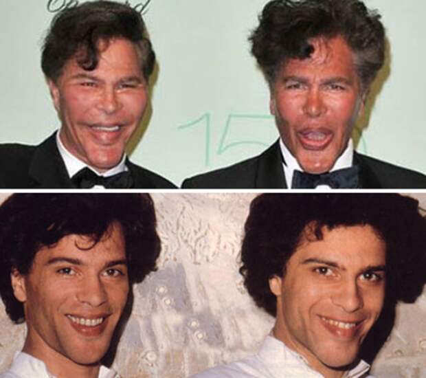 Два брата после пластической операции фото до и после