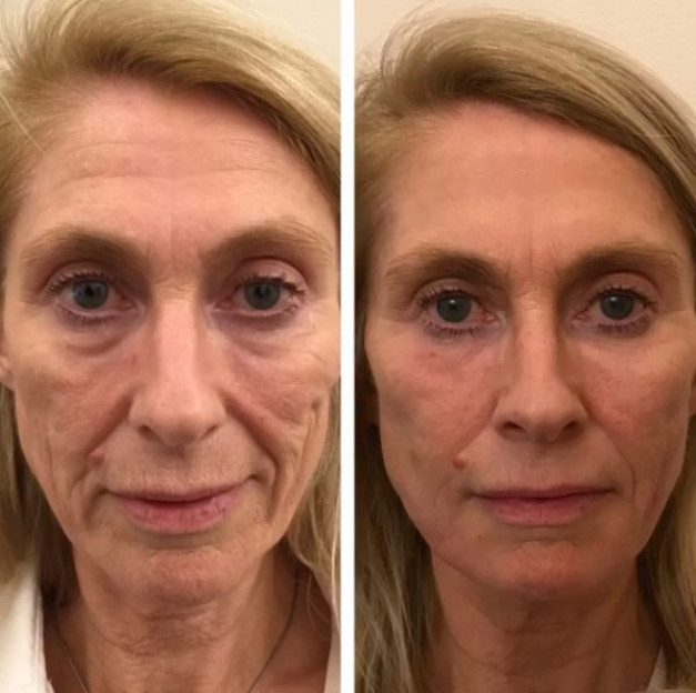 Гиалуроновая кислота для лица уколы фото до и после