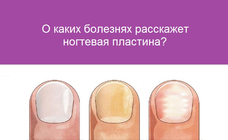 Онихомикоз: профилактика грибка ногтей