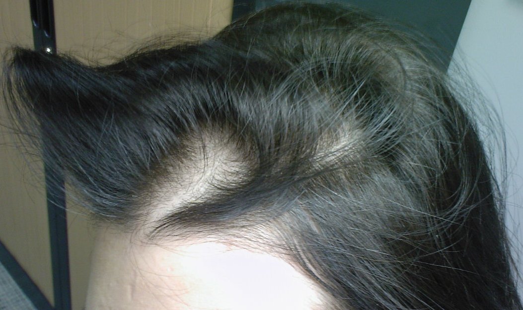 Горячие точки: очаговое выпадение волос у женщин