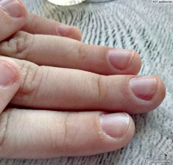 Ребенок грызет ногти: 5 серьезных причин и совет комаровского ❗️☘️ ( ͡ʘ ͜ʖ ͡ʘ)