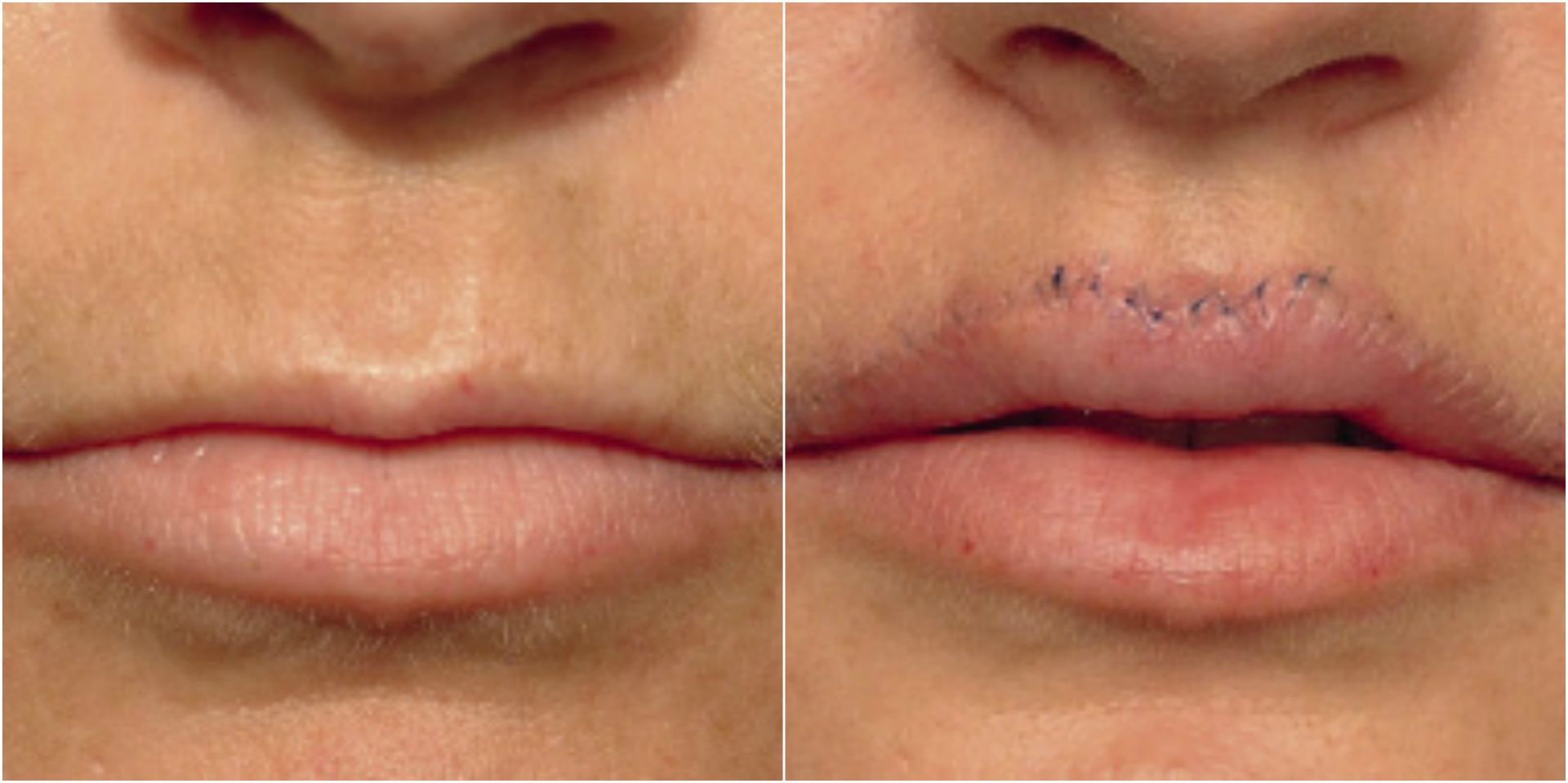 Операция нижней губы. Хейлопластика Кессельринг. Хейлопластика булхорн. Хейлопластика Кессельринг до и после.