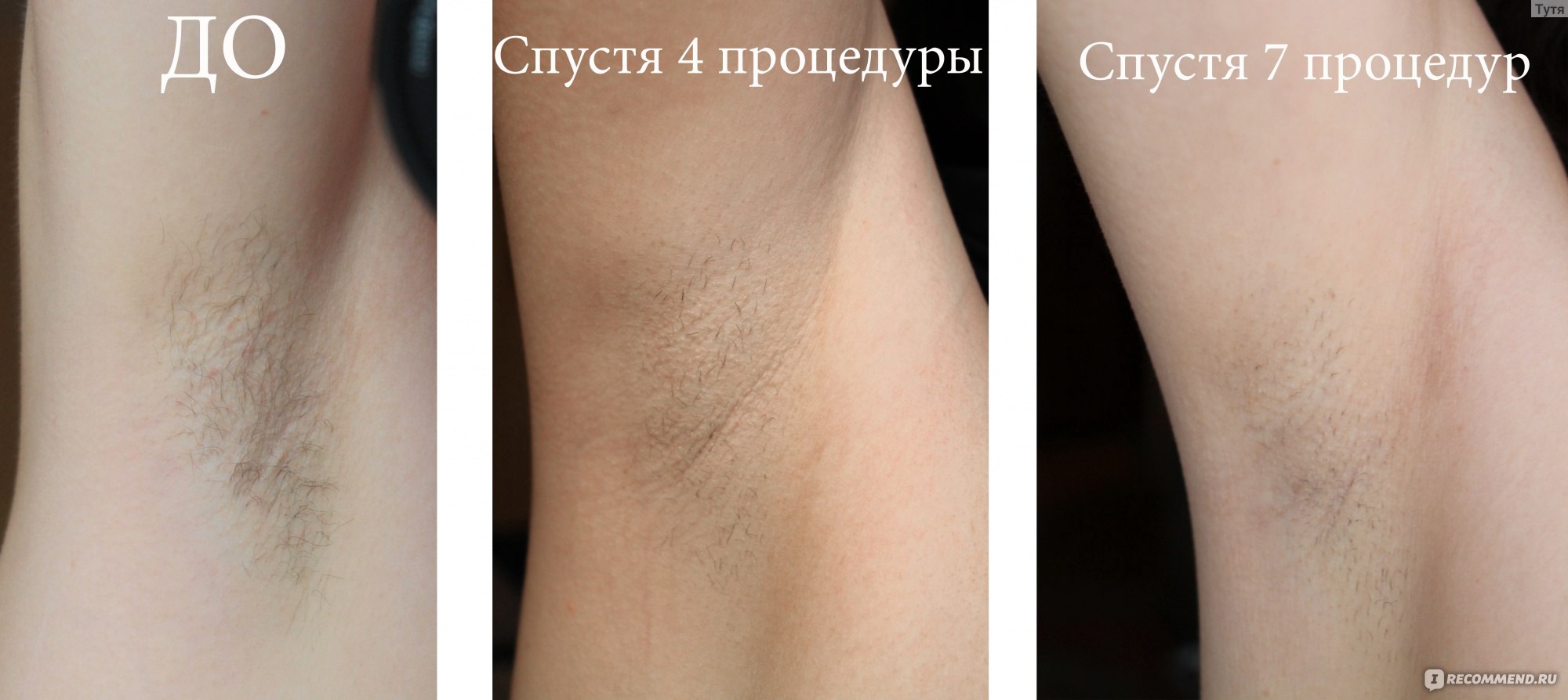 Фотоэпилятор SMOOTHSKIN Muse