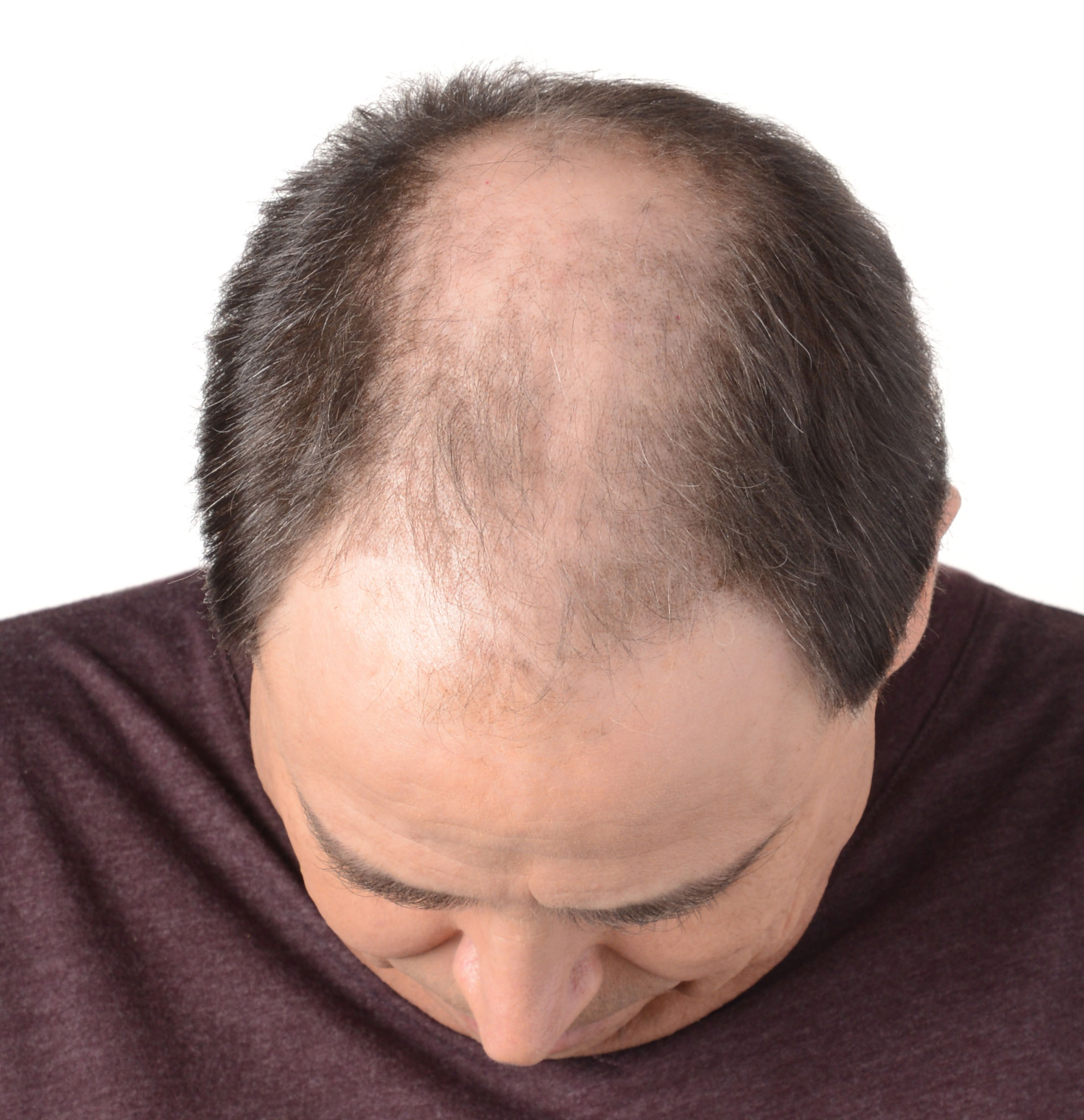 Выпадение волос у мужчин в молодом возрасте: причины, лечение и профилактика