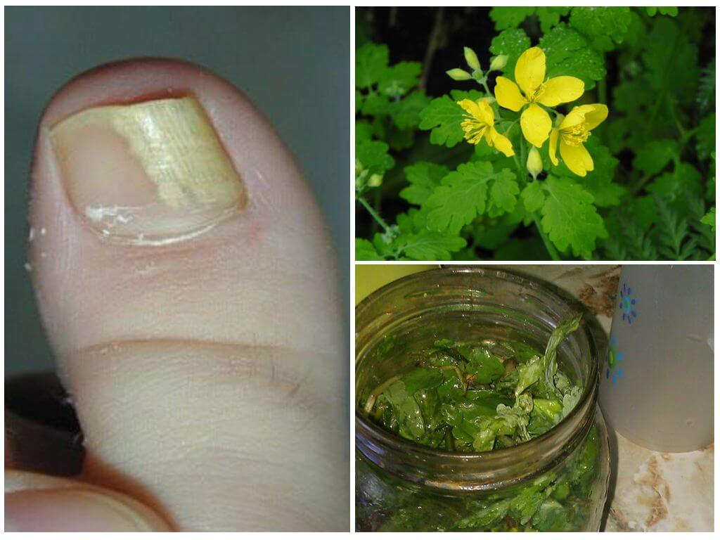 Лечение маслом и соком чистотела грибка ногтей на ногах