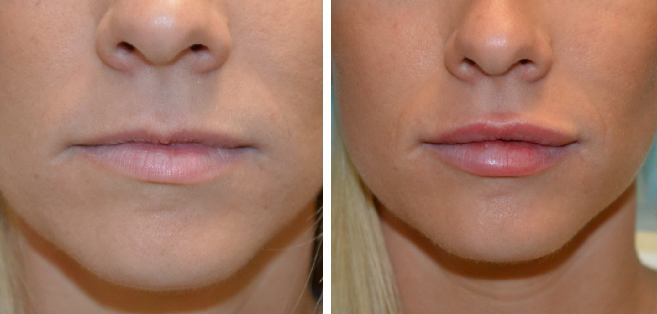 Контурная пластика губ, коррекция носогубных складок и лица, фото до и после.