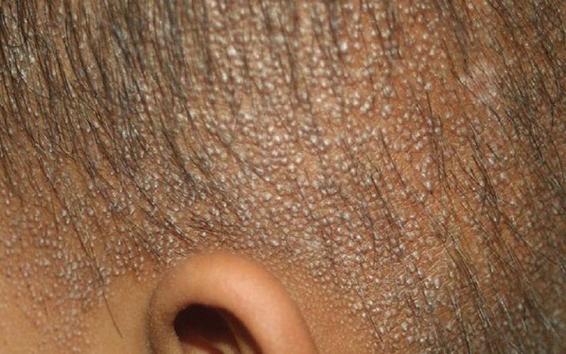 Гиперкератоз кожи: виды, признаки, лечение