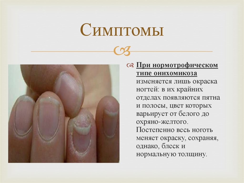Причины пожелтения ногтей на руках