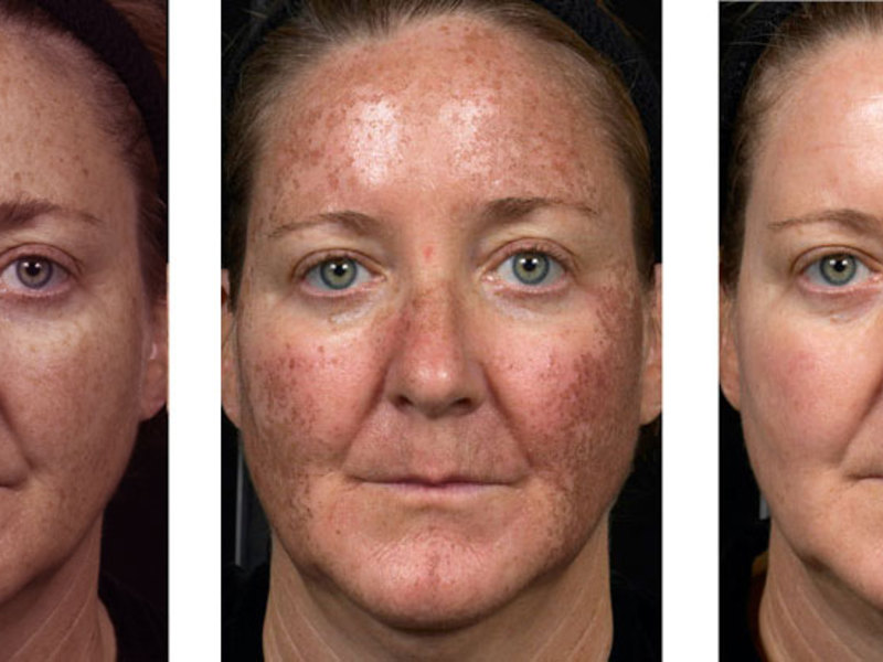 Биоревитализация лица до и после эффект фото