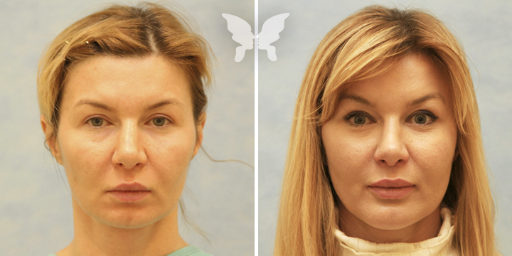 Подтяжка средней трети лица фото до и после
