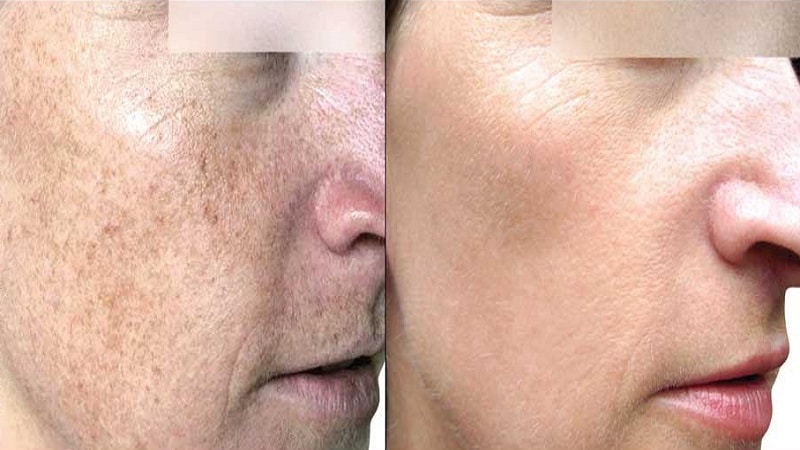 Удаление пигментации лазером на лице до и после фото