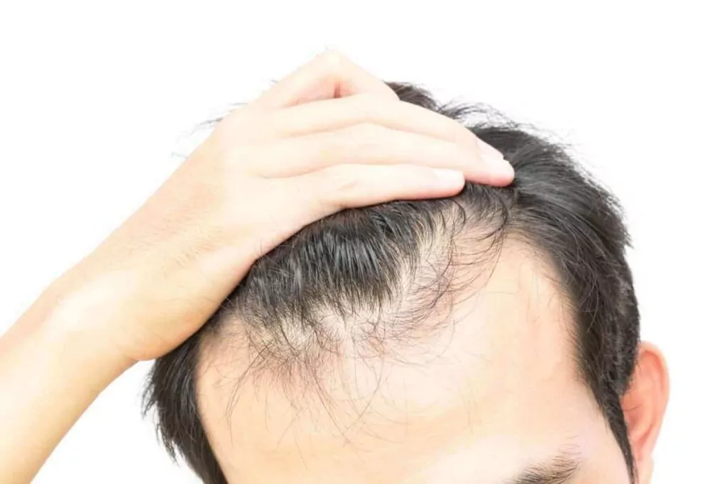 Диффузное выпадение волос у женщин – публикации – лаборатория ан-тек