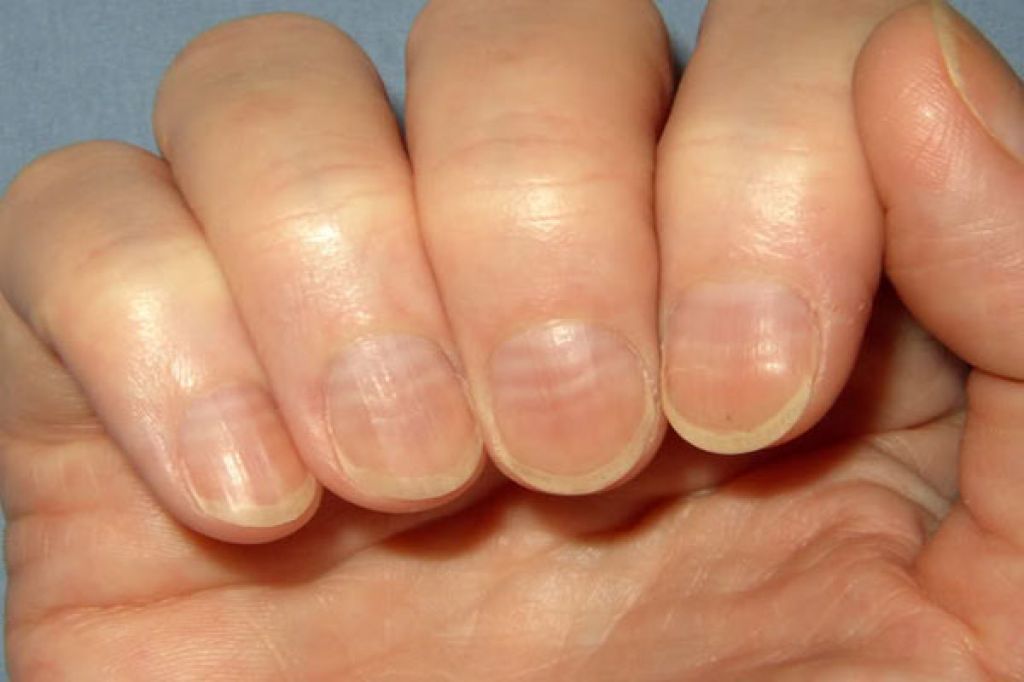 Неровные ногти: почему на них появляются точки, бугорки и бороздки