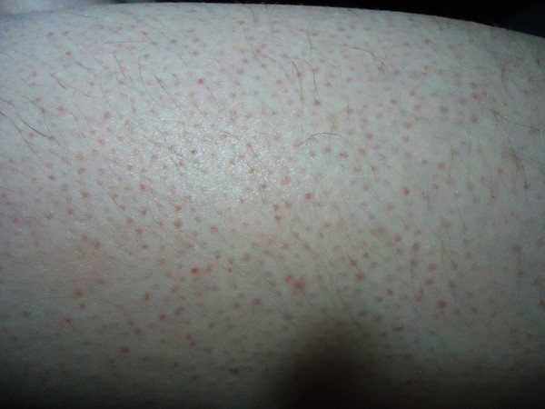 Влияние заболеваний печени на состояние кожи | клиника эксперт