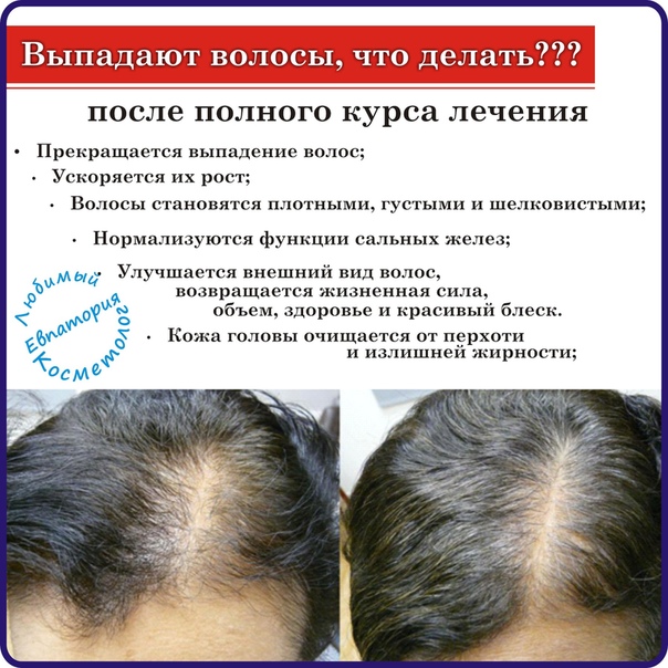 Причины сильного выпадения волос и их лечение