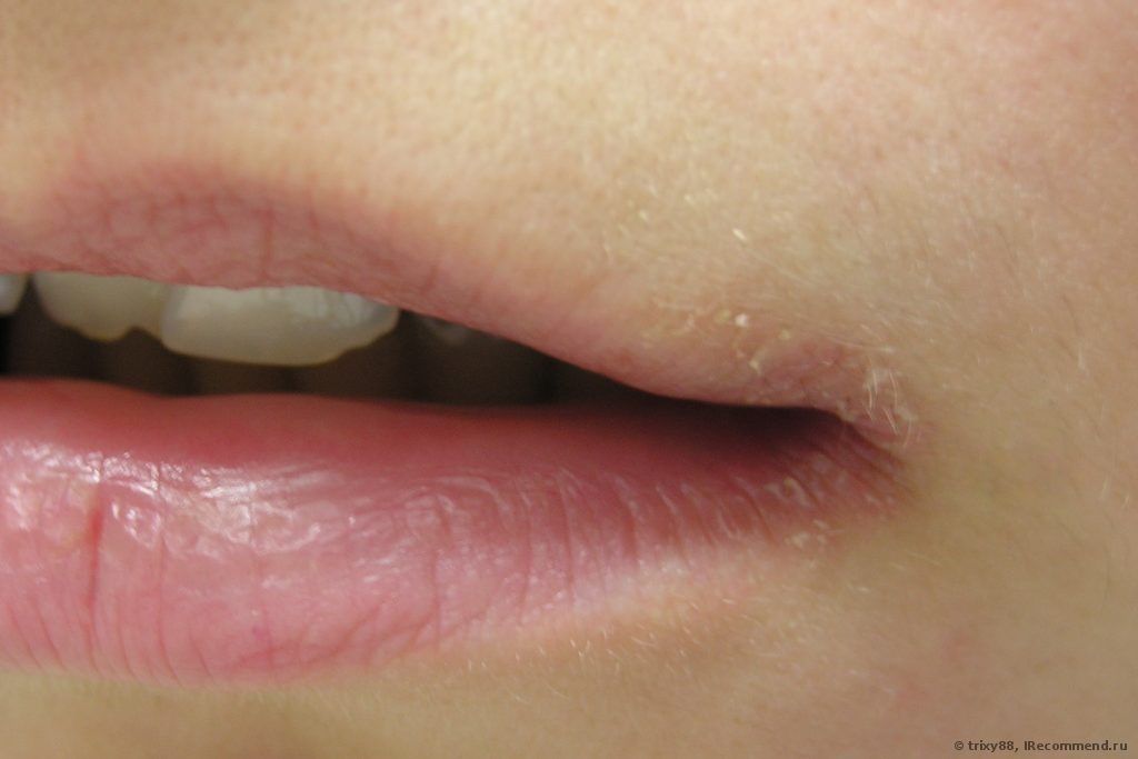 Трещины в уголках губ | eurolab | стоматология