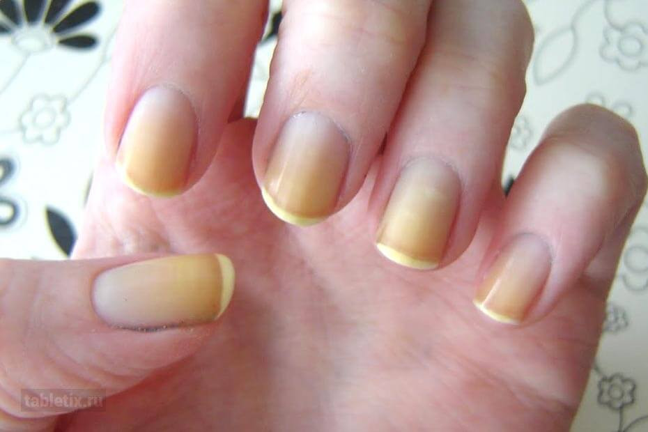 Почему желтеют ногти на руках у женщины - причины, лечение