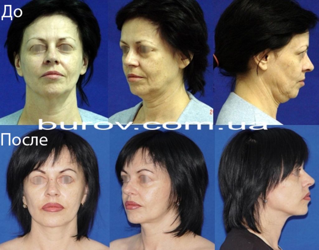 Подтяжка лица смас операция фото до и после