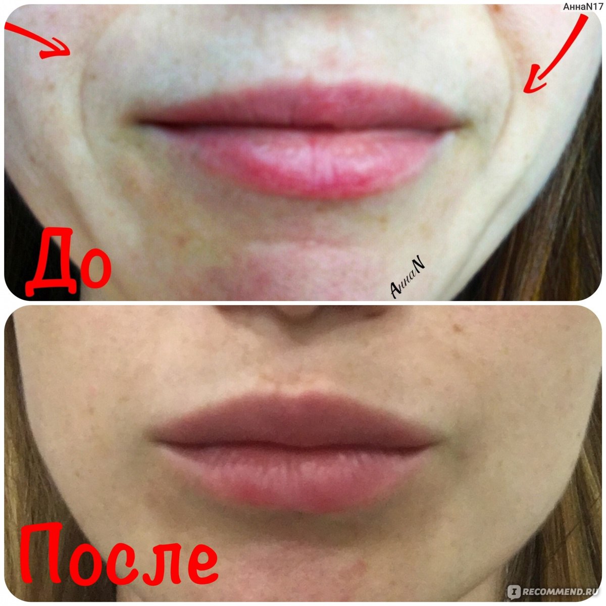 Увеличение губ. в каких случаях можно или нужно делать. противопоказания - «primaderm»
