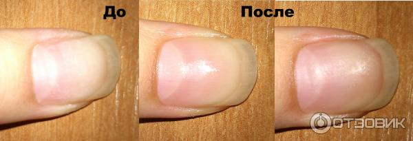 Как восстановить ногти после наращивания: лечение и укрупление